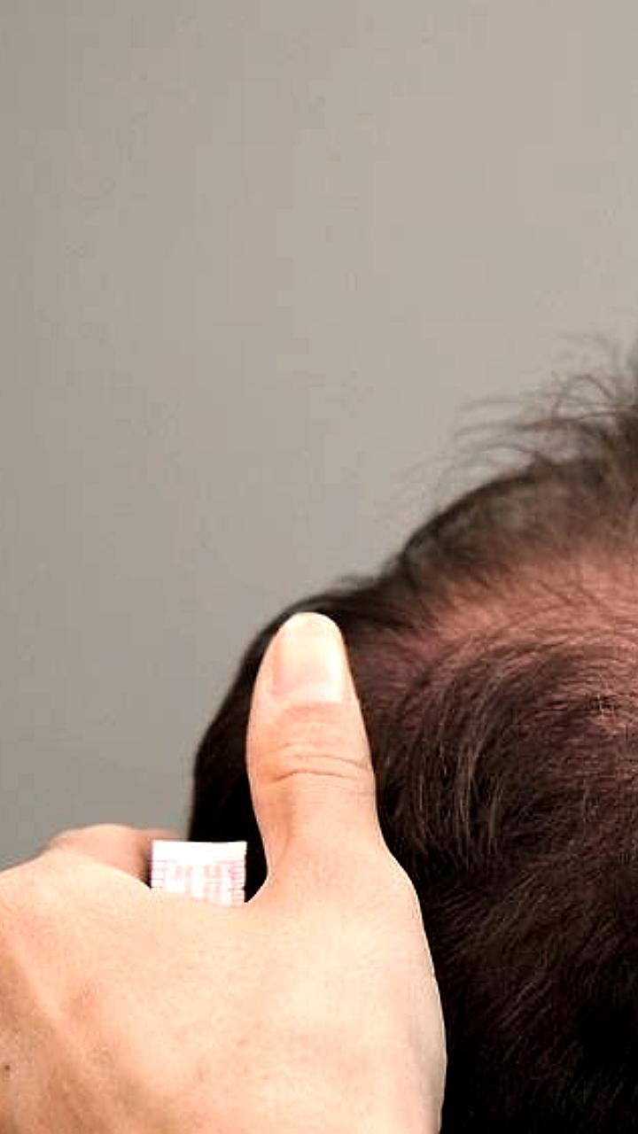 Эксперты предупреждают о росте цен на лечение облысения с 1 января