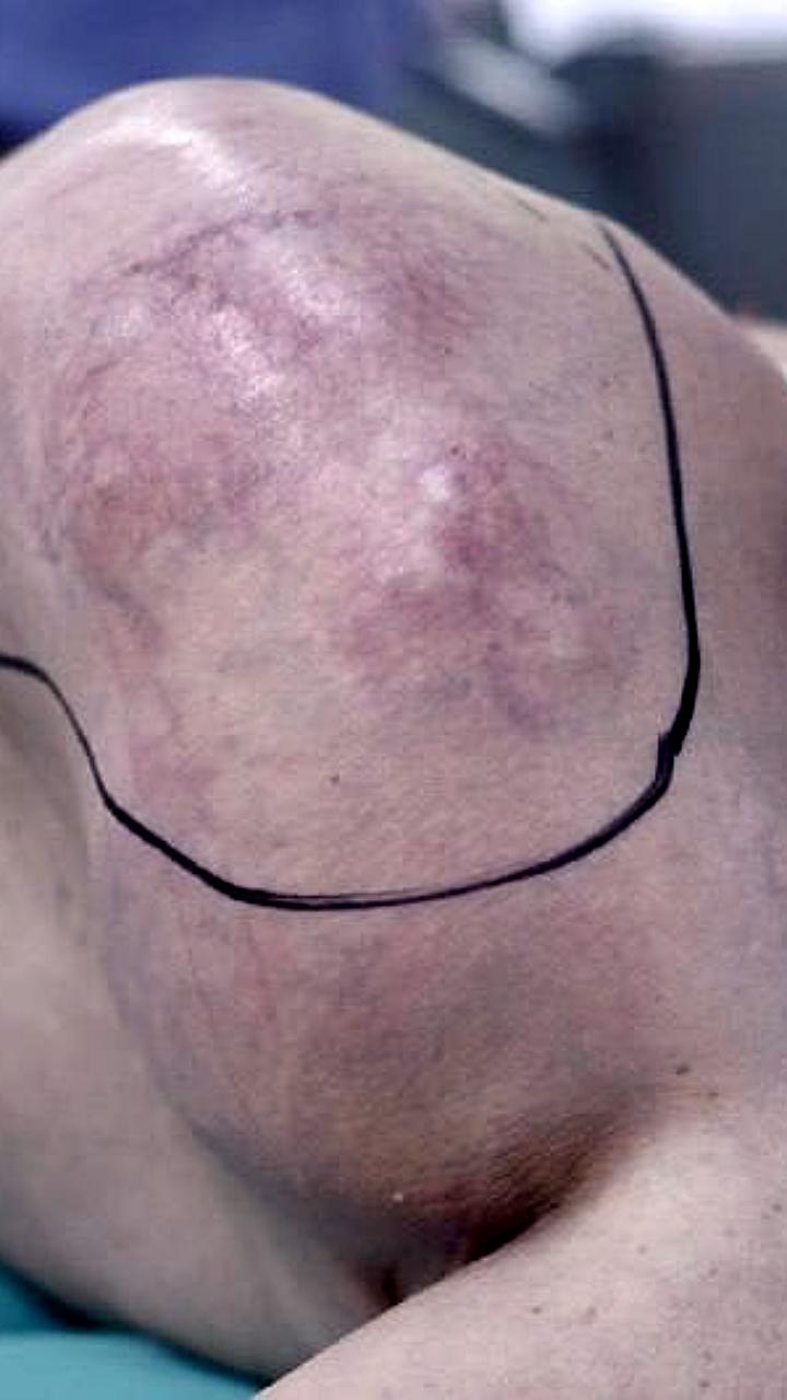 Врачи МРНЦ и Детской больницы успешно провели операции на грудной клетке и яичниках