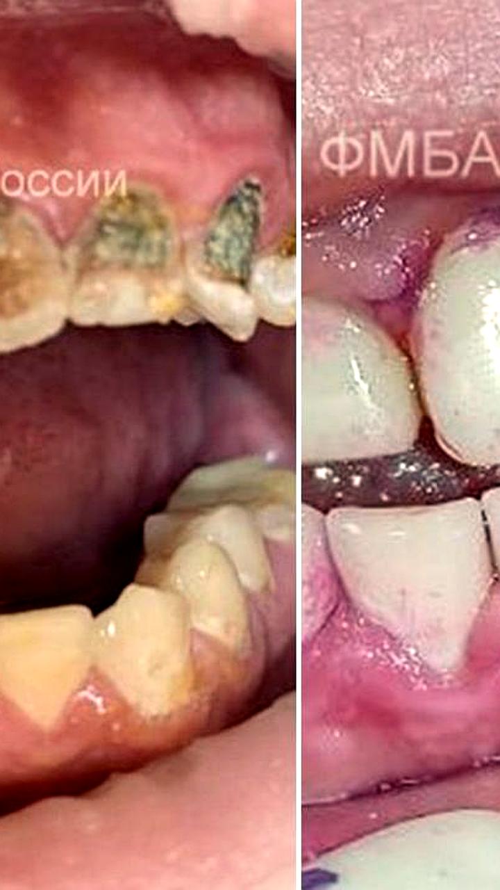 Молодой нижегородец столкнулся с проблемами зубов из-за чрезмерного употребления энергетиков