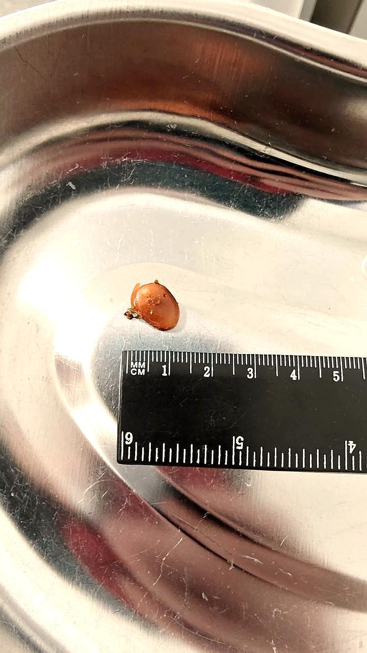 Житель Подмосковья восстановил слух после удаления беруши, застрявшей в ухе два года