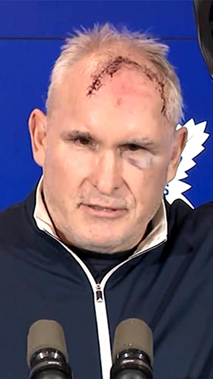 Главный тренер Торонто Крэйг Беруби получил травму головы в спортзале