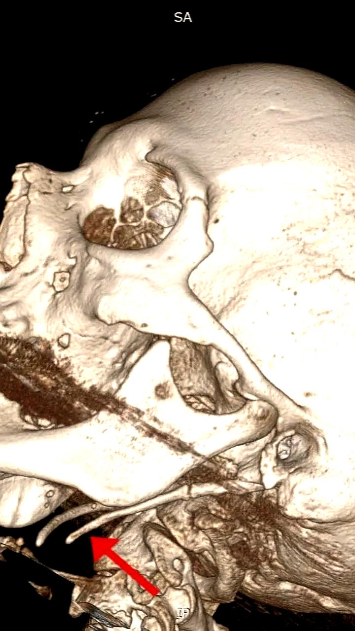 Барнаульские врачи успешно спасли пациентку от ампутации ноги