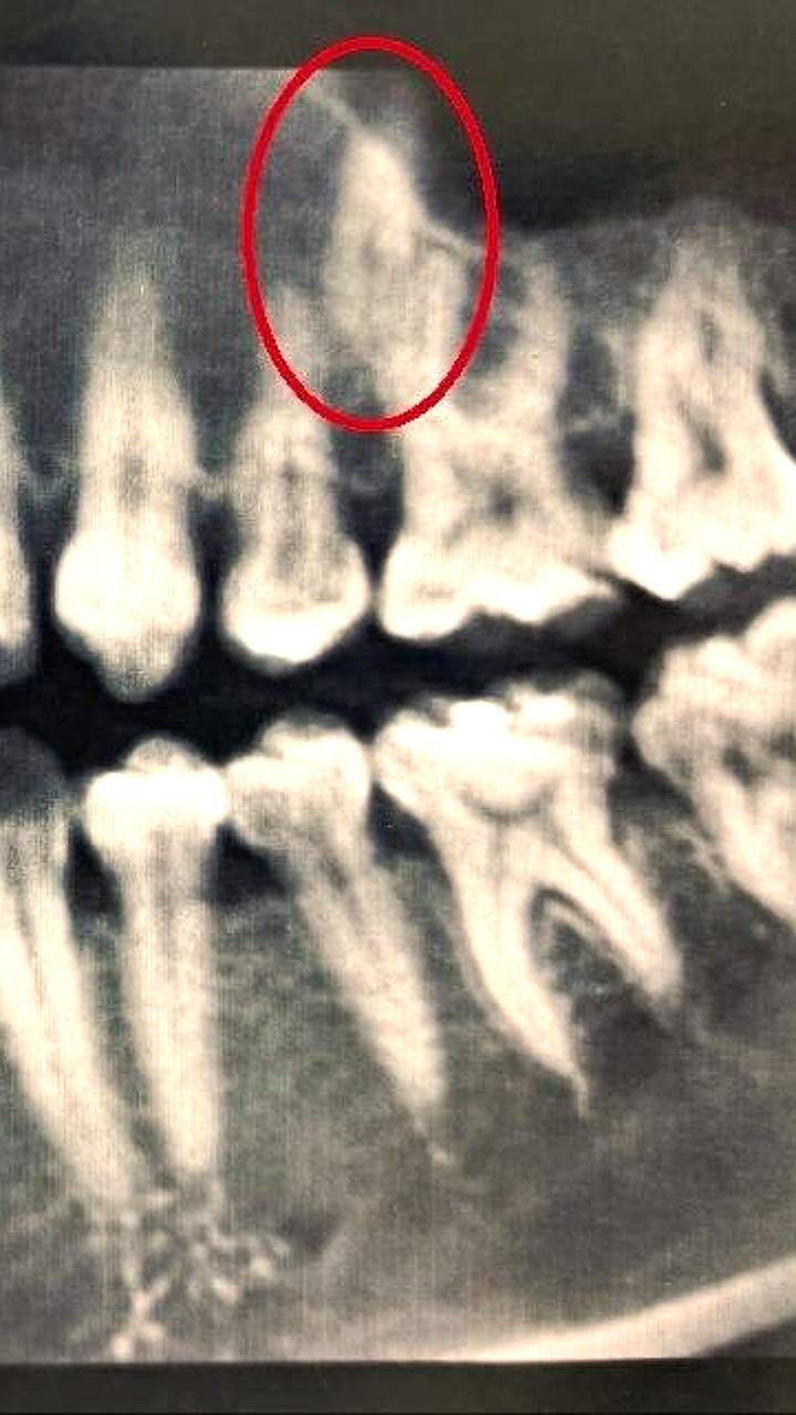Спортсмен и итальянка потеряли зубы из-за некачественного лечения в клиниках