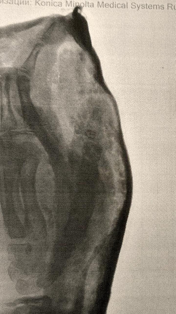 Дети пострадали от взрыва петарды в Северной Осетии