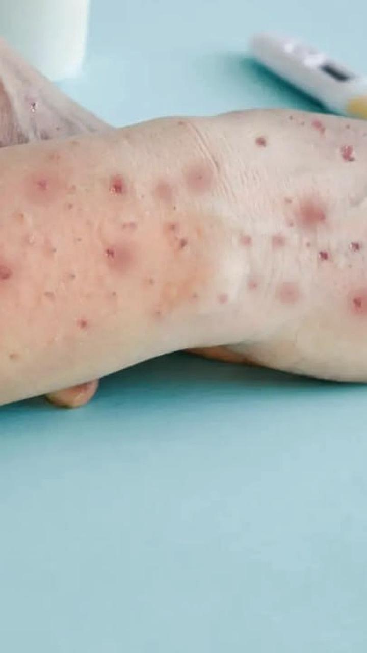 Госпитализация пациентов с подозрением на оспу обезьян в Подмосковье