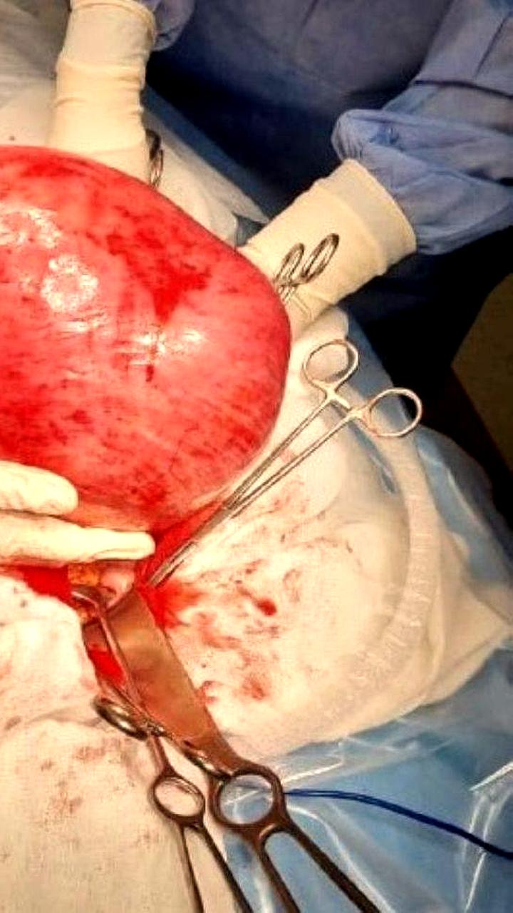 Во Владивостоке успешно удалили миому матки весом 15 кг у 60-летней женщины