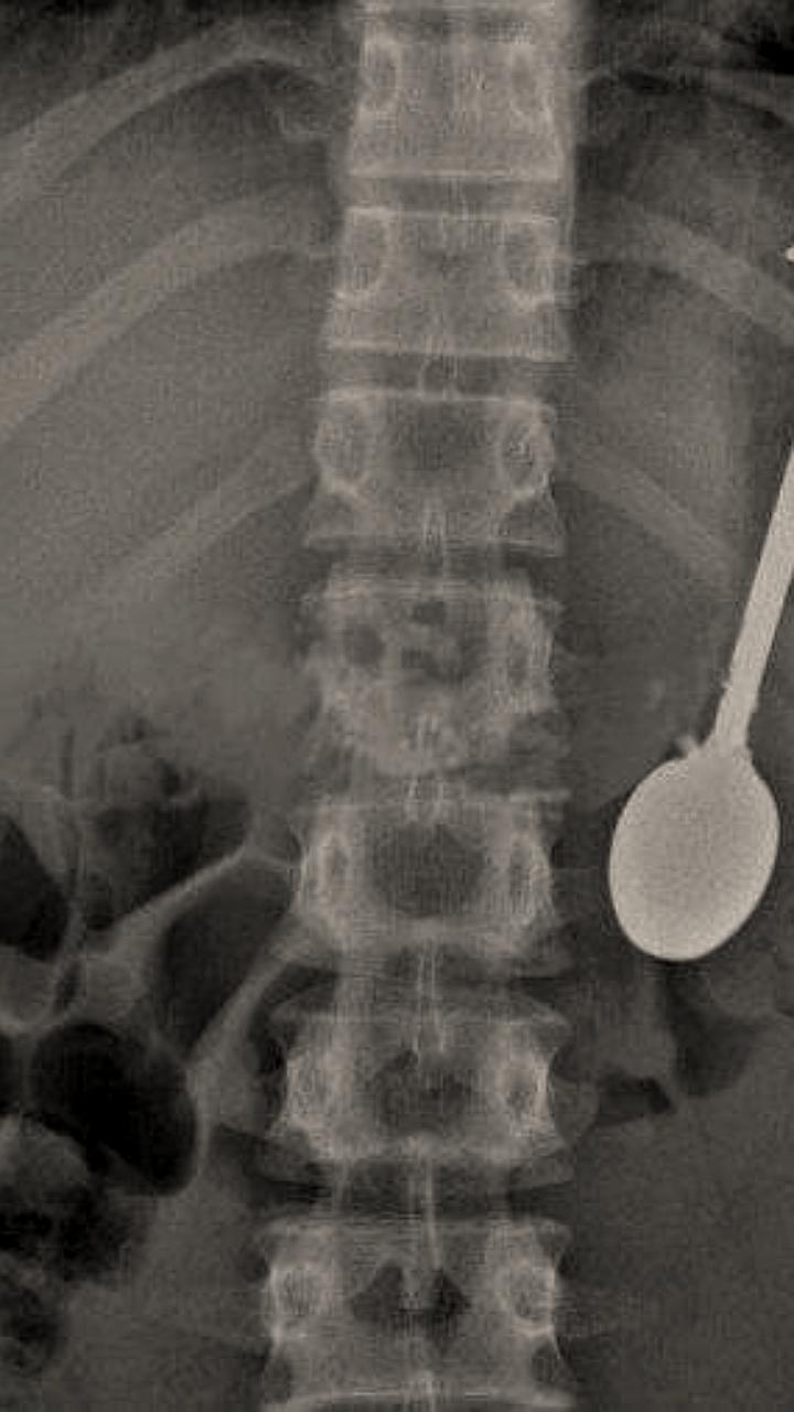 В Оренбурге врачи успешно извлекли ложку из желудка ребенка без разрезов