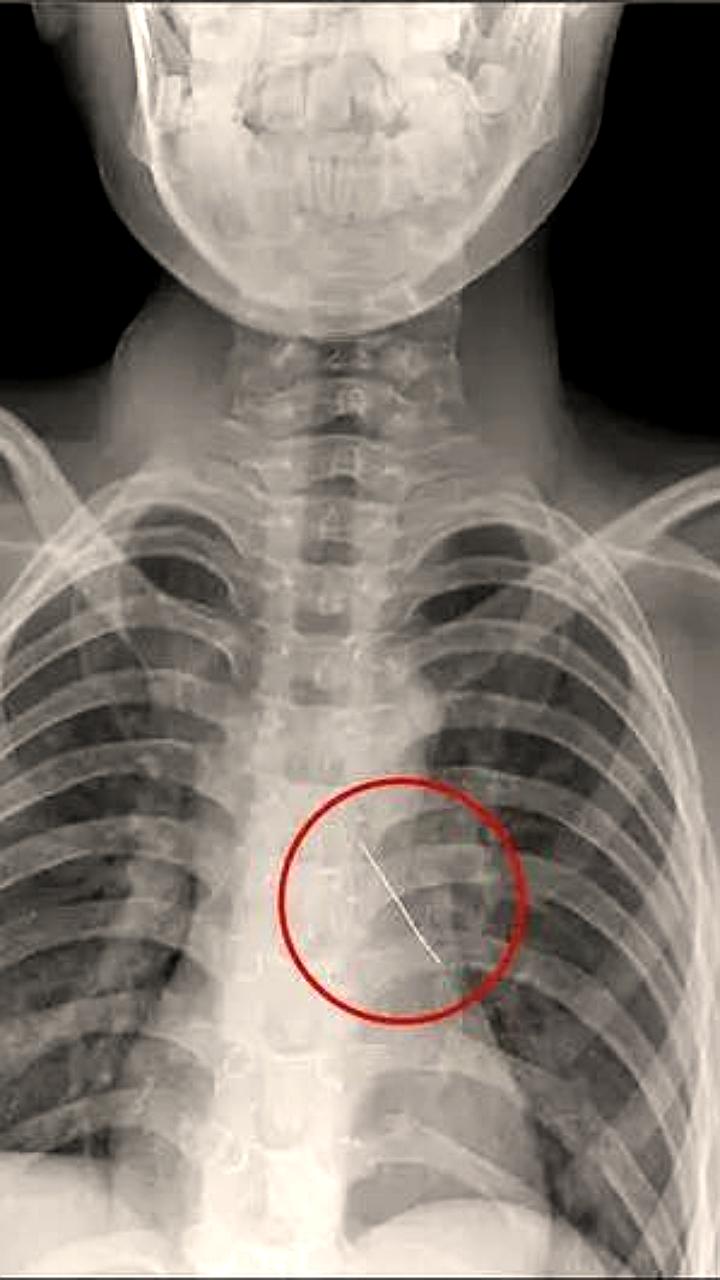 Хирурги Москвы успешно извлекли булавку из бронха 11-летнего мальчика из Калининграда