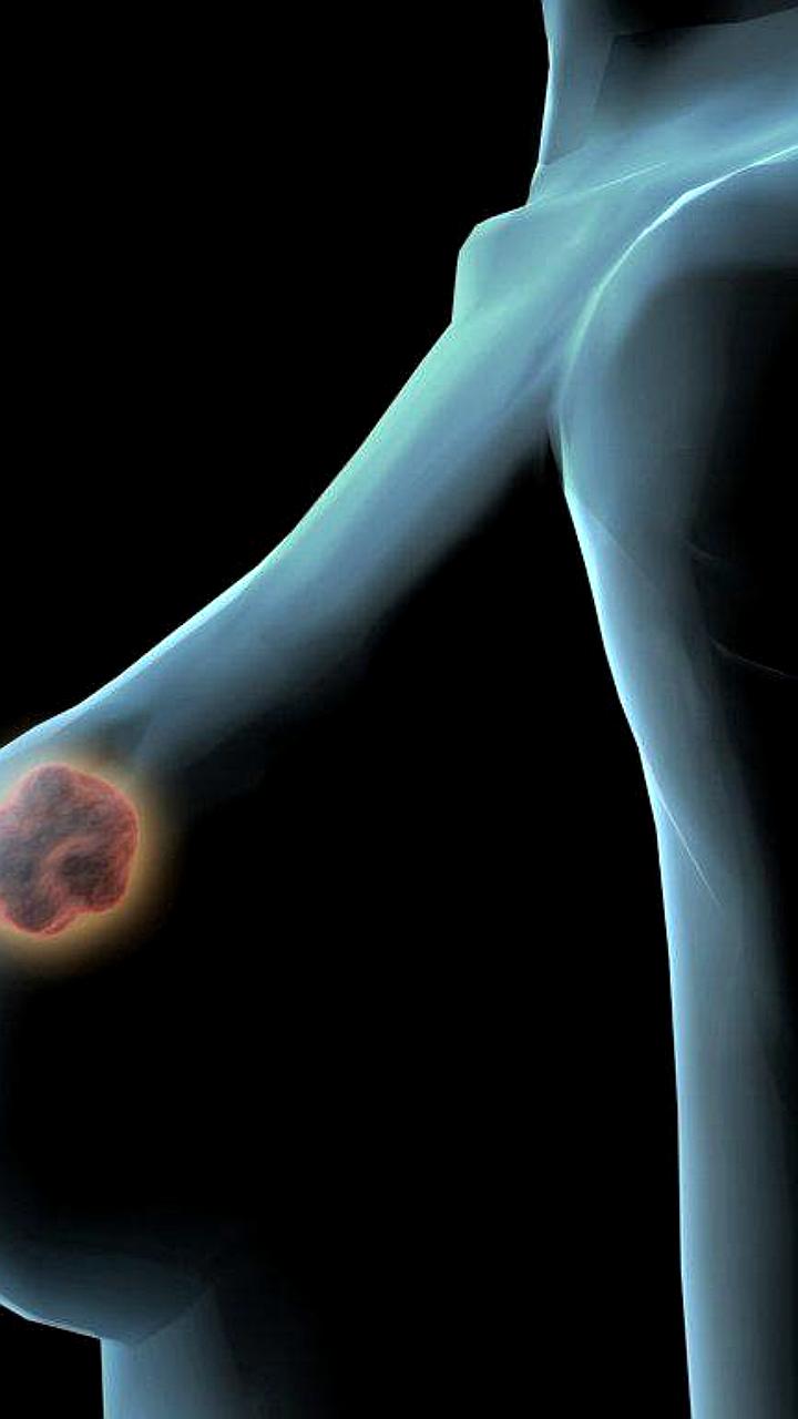 Рост заболеваемости онкологическими заболеваниями среди женщин в России