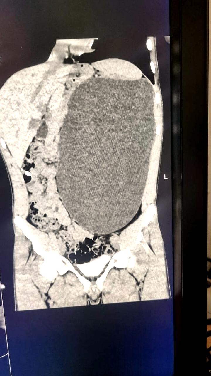 В Новосибирске подростку удалили почку размером с пятилитровую бутылку