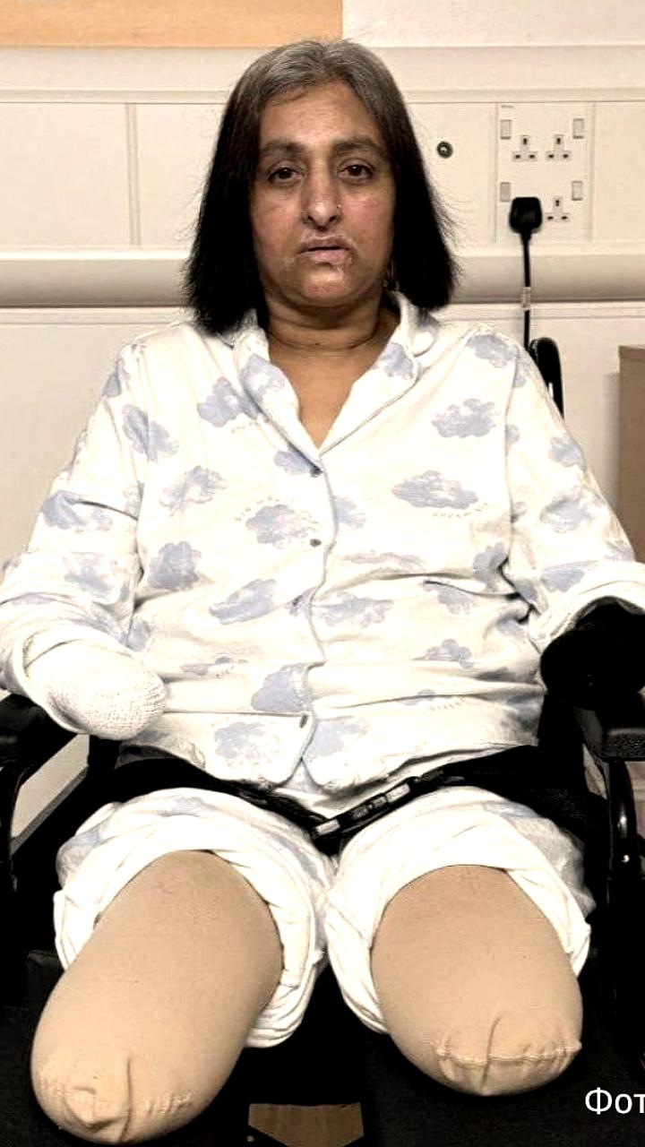 Британка Манджит Сангха перенесла ампутацию конечностей после игры с собакой