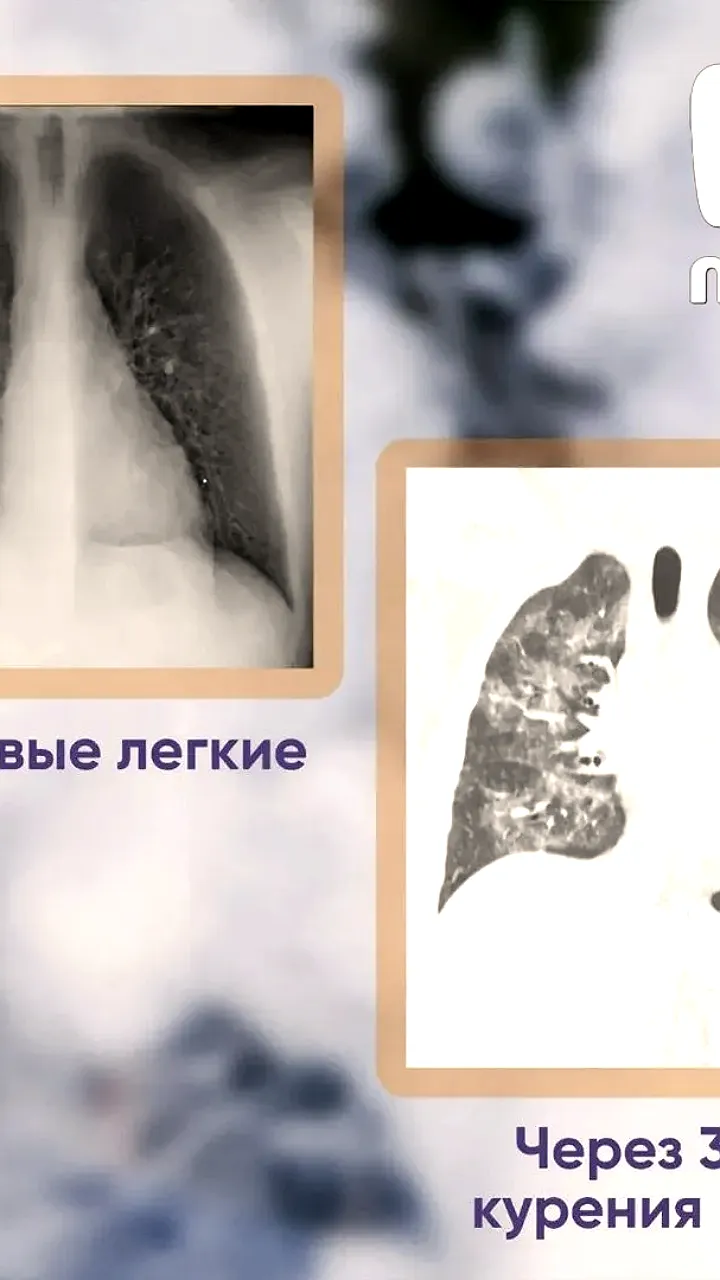 Саратовский юноша стал жертвой вейпинга: тяжелое поражение легких после 5 лет использования